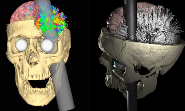 120515072017-phineas-gage-rod-skull-model-story-top